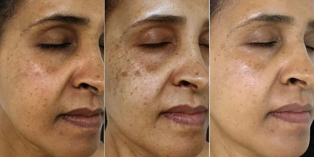 Suero Corrector de Manchas Oscuras de Infinite Love BCN