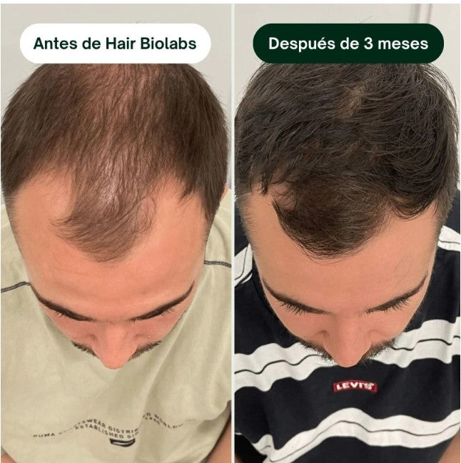 Sérum Anticaída de Doble Acción | Hair Biolabs™