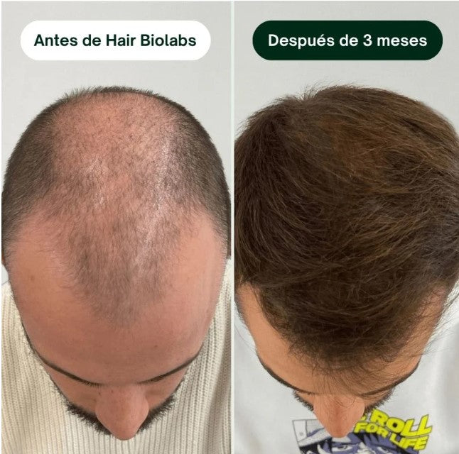 Sérum Anticaída de Doble Acción | Hair Biolabs™