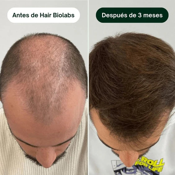 Sérum Anticaída de Doble Acción
