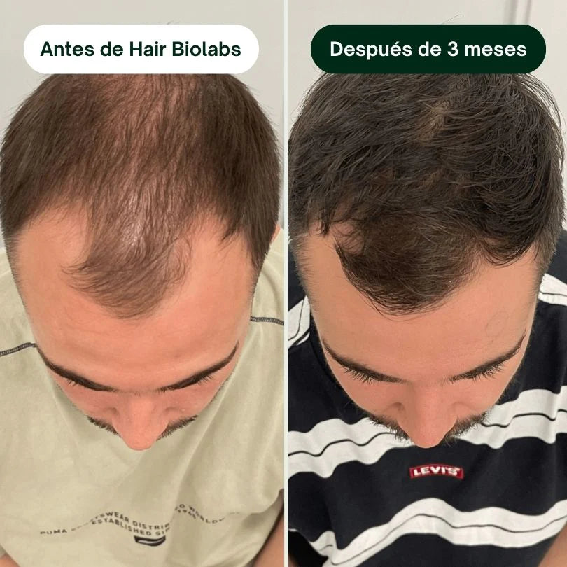 Sérum Anticaída de Doble Acción